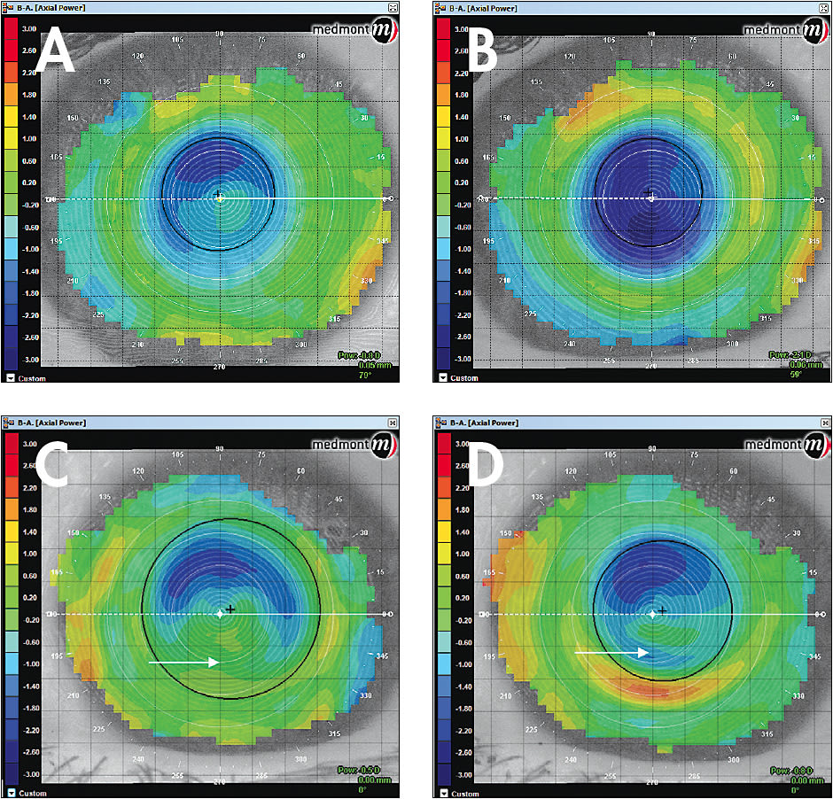 Figure 8. (A) The subtractive map of a spherical lens on an apical astigmatic eye (same as 7A) after one night of lens wear versus (B), which illustrates the difference in treatment of a meridian-specific design on the same eye. Notice the increase in the amount of treatment (diopter value), the flattening that occurred, as well as the area filled in. (C) A smaller area of treatment after one night with spherical lens wear on a limbus-to-limbus astigmatic eye (same as 7C) after one night of lens wear versus (D), which shows a meridian-specific ortho-k lens on the same eye.