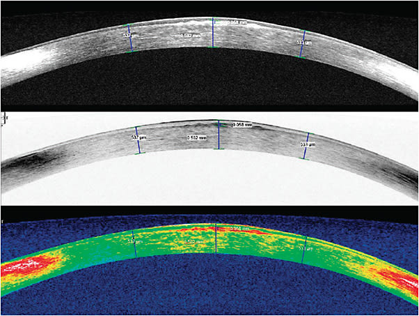 Figure 3. AS-OCT images of the patient&#x2019;s left eye vertical (180&#xBA;) meridian.