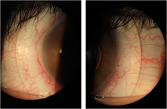 Figure 5. Temporal and nasal views of the haptic and sclera.