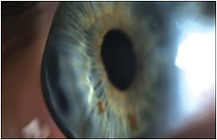 Figure 1. GP optics correct high amounts of irregular astigmatism found in advanced keratoconus.