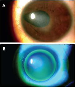 Figure 1. A patient who has Peters anomaly before (A) and after (B) correction with hybrid lenses.