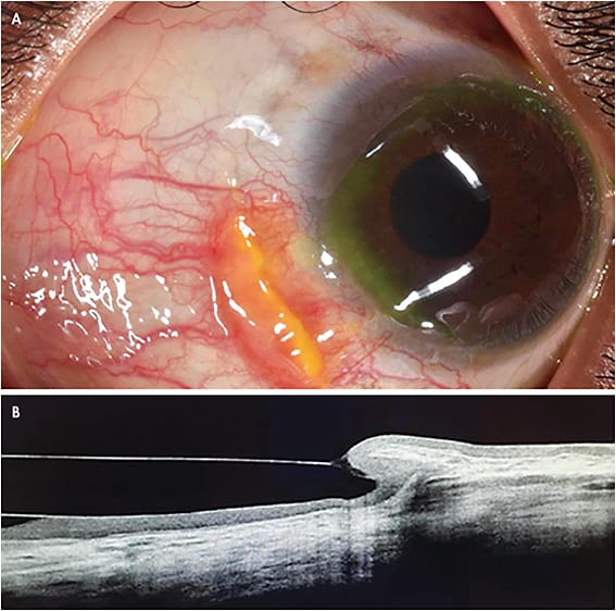 Figure 1. Both images (A and B) show conjunctival hyperplasia caused by incorrect alignment in the landing of the scleral lens. Images courtesy of Cesar A. Rodriguez, OD.