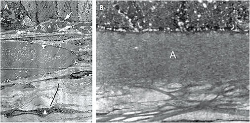 Figure 3A. Ultrastructural view of lamellar keratoplasty button removed from reemerged Thiel-Behnke in cornea illustrated in Figure 1. This view shows the absence of the ALL and its epithelial adhesion components. The basement membrane (arrow) is incomplete and exhibits disruptions. The ALL is replaced by a fibrocellular layer (asterisk). An activated stromal cell (triangle) signals deeper stromal involvement. Electron microscopy approximately 6,000X. Figure 3B. Ultrastructural view of normal cornea showing a complete ALL (A) and healthy anterior stroma. Electron microscopy approximately 8,000X. Reprinted with permission, J. Bergmanson, Clinical Ocular Anatomy and Physiology, Edition 28, 2021.