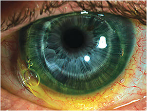 Figure 2. Edge fluting of a hybrid lens fit on an eye diagnosed with keratoconus.