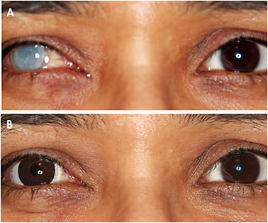 Figure 10. (A) Traumatic injury causing opacification of the cornea; (B) a large 21mm truncated fenestrated hand-painted soft contact lens maximizes alignment.