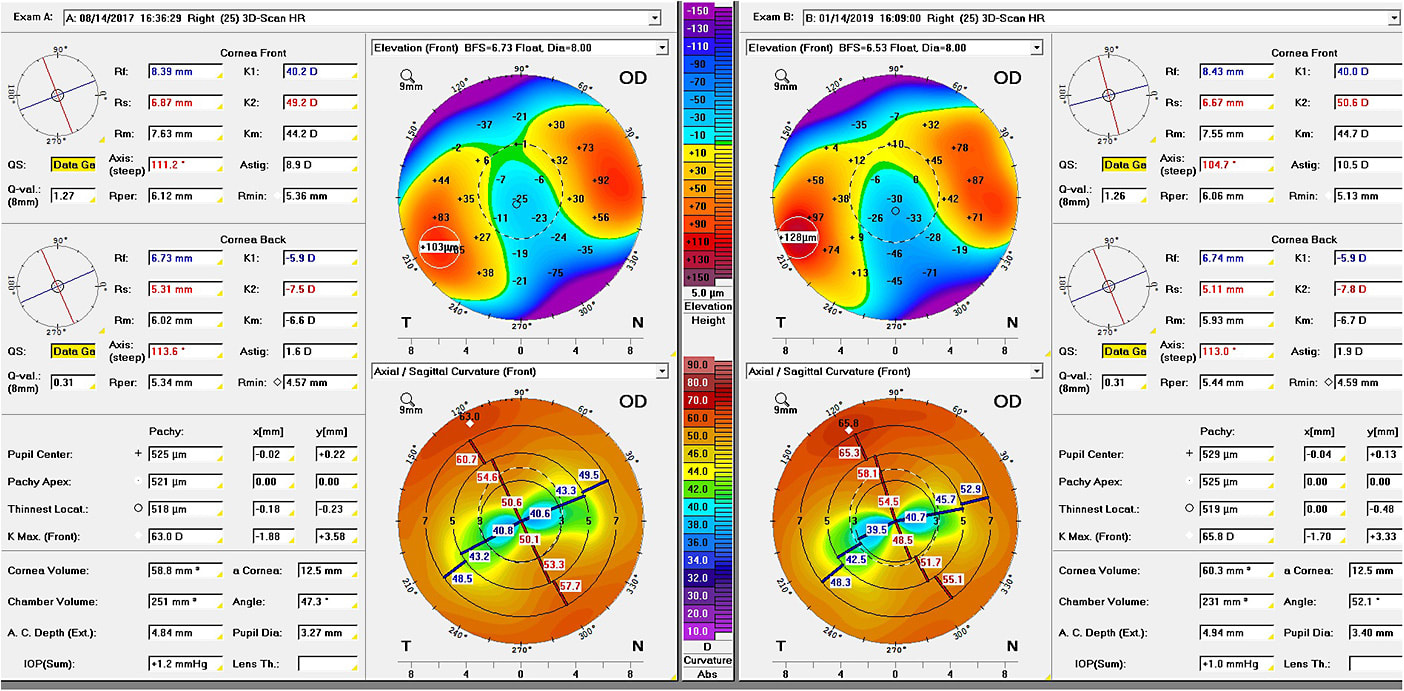 Figure 6. The elevation maps showed that the peripheral bulge continued to rise over the past two years more than 20 microns in some areas and that the annular curvature continues to grow around the much flatter central surface of the graft. One further note is that the curvature in the historically highest part of the cornea between 10 o'clock to 12 o'clock continues to steepen here from 63D to nearly 66D.