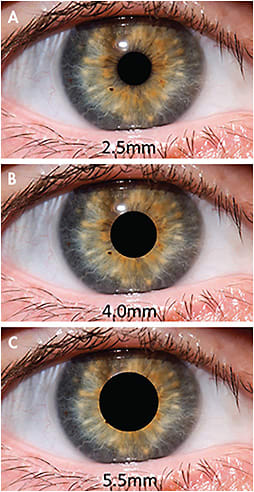 Figure 1. Practitioners need to adjust the optics, depending on their patients&#x2019; pupil size.