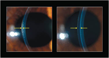 Figure 2. (Left) A standard soft lens on eye, with arrows highlighting central lens thickness. (Right) Custom soft lens for keratoconus, with arrows highlighting increased central lens thickness.