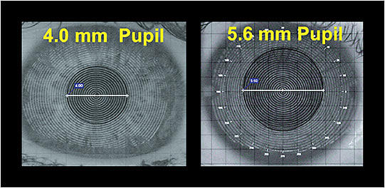Figure 1. Pupil size can impact success with soft multifocal lenses.