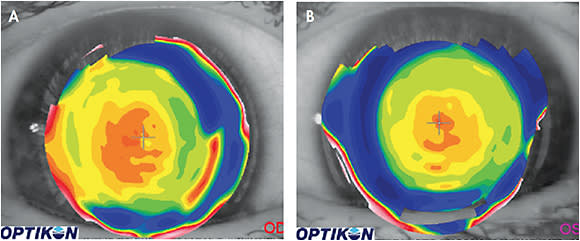 Figure 3. (A) Topography over a near-center multifocal lens on a patient’s right eye showing temporal decentration of the optics relative to the patient’s line of sight. (B) Topography over a near-center multifocal lens on a patient’s left eye showing the desired centration of the optics relative to the line of sight.