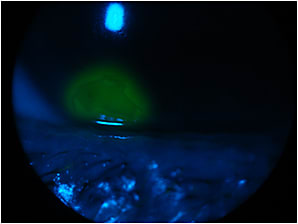 Figure 2. Biomicroscope view of fluorescein staining at the lesion.