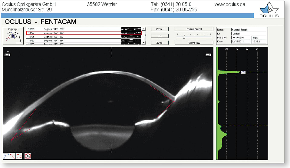 Figure 7. Scheimpflug image along a vertical meridian for an advanced keratoconus patient with stromal central scarring.