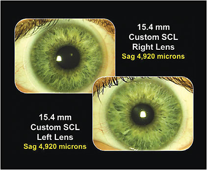 Figure 3. Custom soft lenses with larger overall diameters on the patient’s right and left eyes.