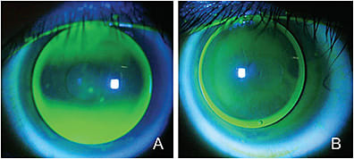 Figure 7. A spherical corneal GP contact lens on a patient who has a with-the-rule cornea (A). A toric-back-surface corneal GP contact lens on the same patient (B).