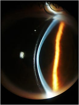 Figure 3. OS scleral lens fit in July 2020.