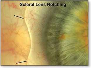 Figure 1. A ”notched” scleral lens.