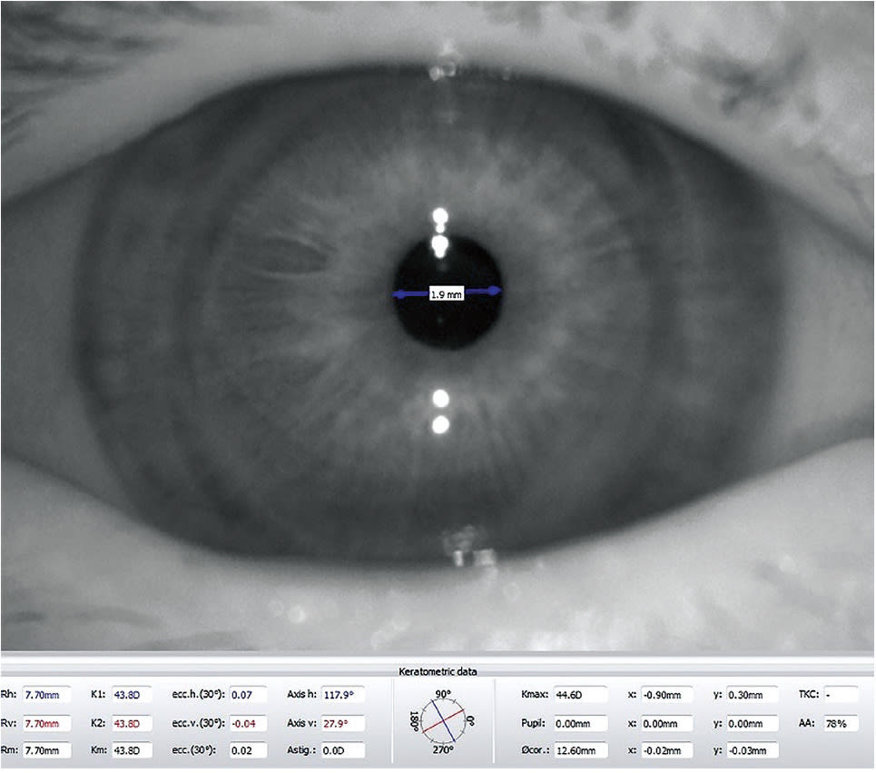 Figure 4A. Image of pupil measurement by topographer in photopic condition.