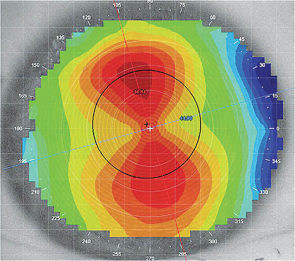 Figure 1. Regular cornea with near limbus-to-limbus astigmatism.