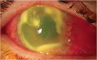 Figure 2. A patient who has an active corneal ulcer/defect with inflammation due to severe Sjögren’s and underlying rheumatoid arthritis. Photo courtesy of Christopher Hood, MD, Kellogg Eye Center