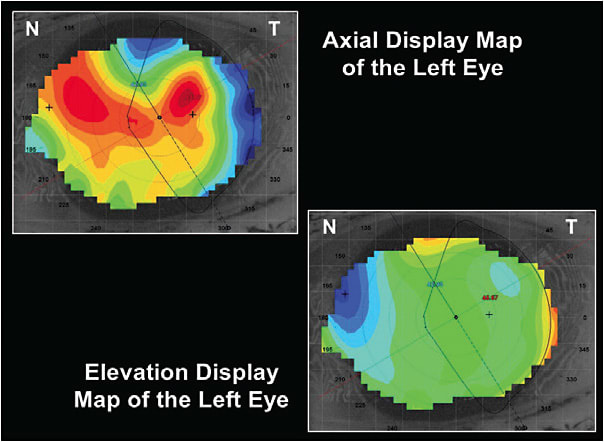 Figure 2. Axial and elevation display maps of the left eye at the time of contact lens fitting. Note the against-the-rule astigmatism with the axial display map &amp;#xA;and the corneal depression (blue zone) on the nasal side of the elevation display map.