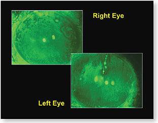 Figure 2. The ocular surface of the patient without his scleral lenses.