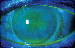 Figure 1. Solution toxicity secondary to preservatives inside the fluid reservoir of a scleral lens.