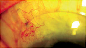 Figure 3. The 14.0mm lens in downgaze and its position in relation to the shunt and bleb.