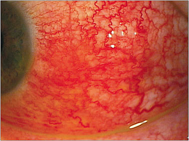 Figure 3. Nodular episcleritis.&#xD;&#xA;Courtesy of Daniel Deligio, OD, Chicago College of Optometry