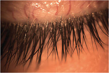 Figure 2. Blepharitis can cause discomfort issues with certain contact lens materials.