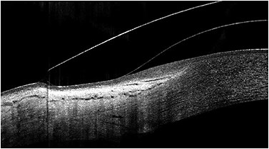 Figure 11. AS-OCT is able to image the corneal vault and haptic landing of a scleral contact lens over the ocular surface.