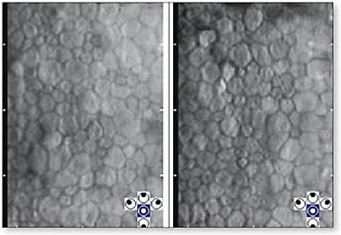 Figure 3. Specular microscopy of a case of contact lens-induced endotheliopathy due to more than a decade of continuous overnight wear of low-oxygen-permeable contact lenses.