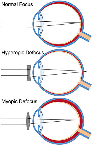 Figure 1. Schematic diagram illustrating the short-term changes in choroidal thickness (red tissue) that occur in the human eye in response to optical blur. With normal focus (top), the image is focused sharply on the retina, and the choroidal thickness remains stable. With hyperopic defocus (middle), the image is focused behind the retina, and a small-magnitude thinning of the choroid occurs. With myopic defocus, the image is focused in front of the retina, and the choroid thickens by a small amount. These choroidal changes move the retina in the direction of the defocused image plane. In animal models of myopia development, these choroidal responses precede longer-term changes in eye growth and refractive error development in response to optical blur.