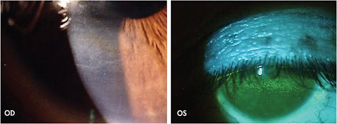 Figure 4. (Left) corneal vascularization OD; (Right) interpalpebral staining OS.