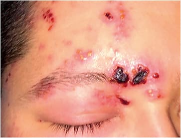 Figure 1. Skin lesions in HZO.