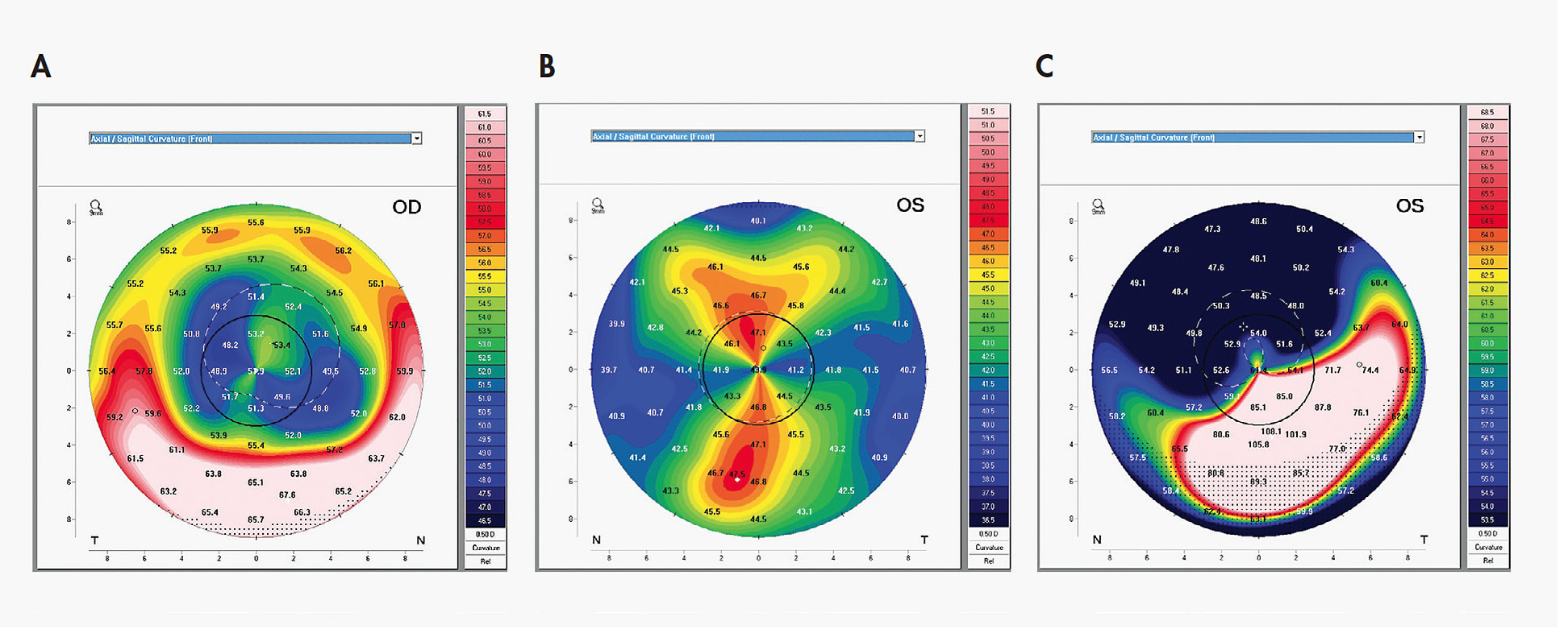 Figure 5. Axial topography of post-PK corneas. (A) Oblate corneal curvature. (B) Prolate astigmatic corneal curvature. (C) Steep-to-flat corneal curvature.