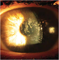 Figure 2. Surface deposits on the left scleral lens.