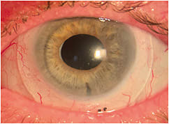 Figure 1. High-plus scleral lens for the correction of aphakia.