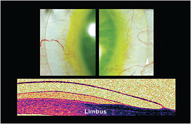 Figure 2. The water-tight seal created by a well-fitted scleral lens.