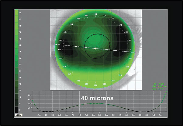 Figure 3. The simulated fluorescein pattern generated from the elevation display map.