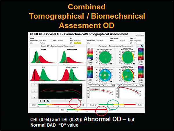 Figure 3. Normal Scheimpflug tomography in an eye that has abnormal corneal biomechanics; the eye is felt to be abnormal when combining the data.