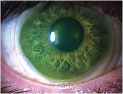 Figure 1. Asymptomatic with mild conjunctival prolapse.