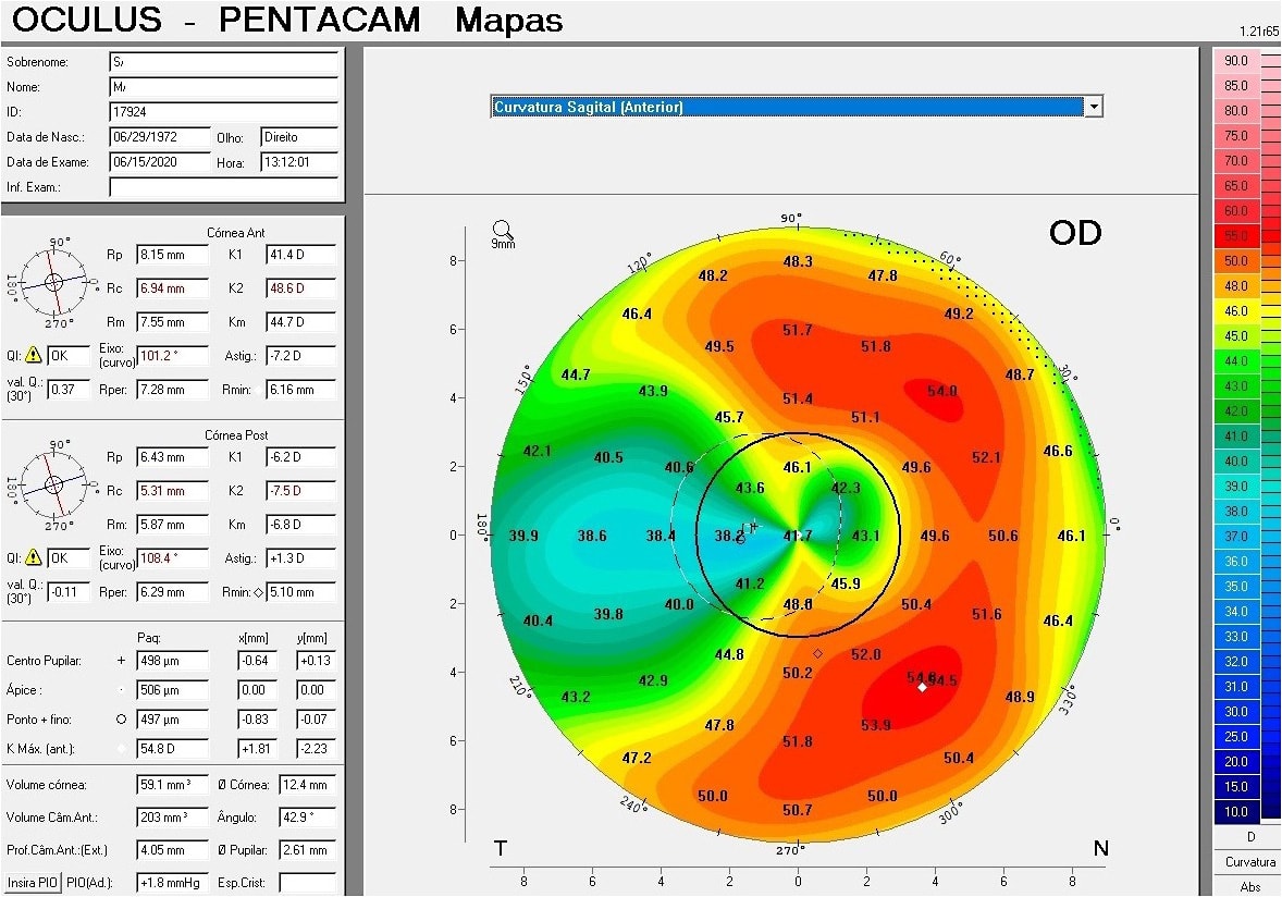 Figure 2. Anterior sagittal map OD in June 2020.