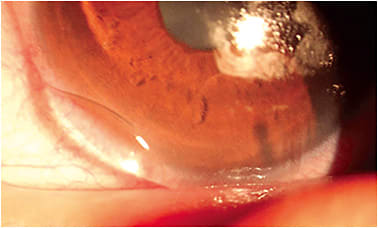 Figure 2. A poor soft lens fit resulting in edge fluting.