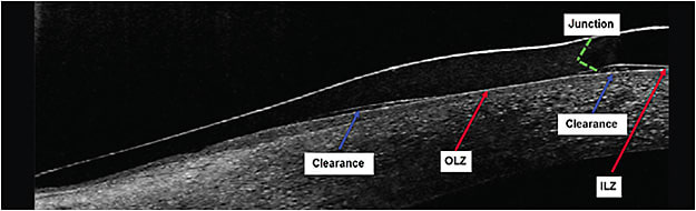 Figure 1. OCT of the hybrid lens junction and adjacent landmarks.