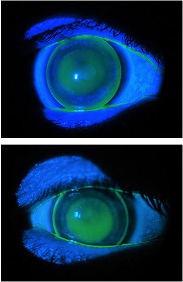 Figures 7 and 8. The new fit in 2013, with apical clearance and excellent fluorescein pattern OD and OS.