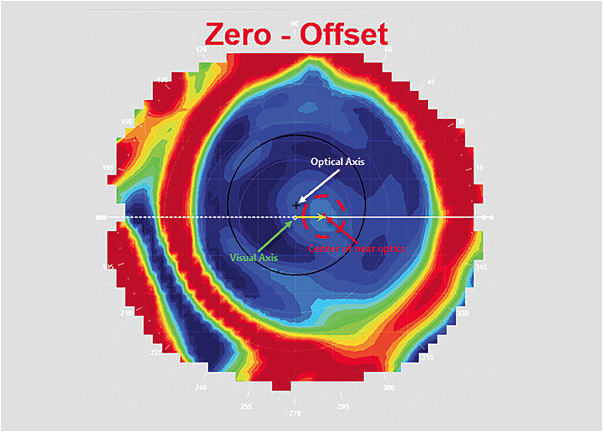 Figure 1. OS, 0.77mm misalignment (yellow arrow), direction: temporal.