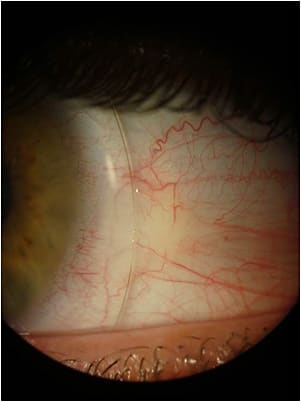 Figure 8. The same eye after nine hours of uninterrupted wear.