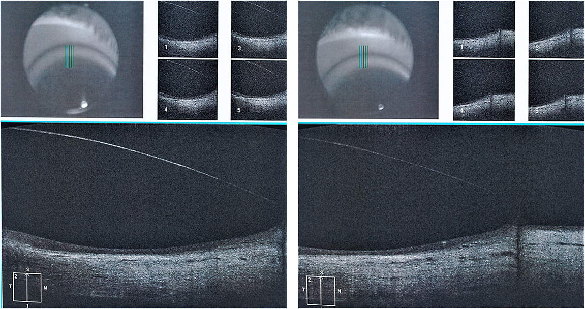 Figures 9 and 10. OCT images of the upper haptic and sclera.