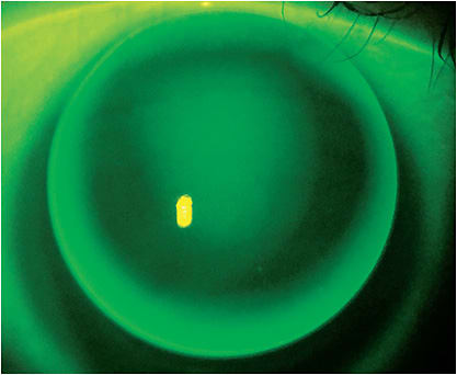 Figure 1. A well-fit back-surface aspheric multifocal showing a slightly steep pattern.