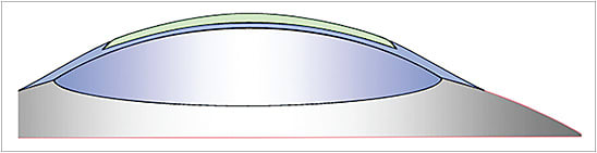 Figure 3. A recessed piggyback design.